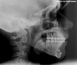 Marie-Hélène Cyr - Cephalometric X-ray after the orthognathic surgeries (April 22, 2008)
